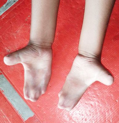 सिंडक्टिली व जन्मजात हृदय रोग का महंगा ऑपरेशन चिरायु से नि:शुल्क