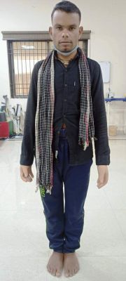 मंत्री अमरजीत भगत के सहयोग से दिव्यांग मोहर को मिला कृत्रिम हाथ