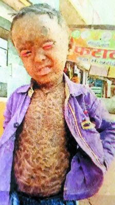 दुर्लभ बीमारी से ग्रसित है बालक