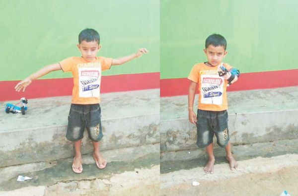 हेमीप्लेजिया से ग्रसित नन्हें निकेश के हाथों में फिर आई जान