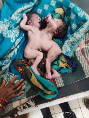 पेट से जुड़ी दोनों बच्चियों की मौत