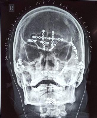  क्षतिग्रस्त चेहरे को 8 घंटे का ऑपरेशन कर विकृत होने से बचाया सिम्स के डॉक्टरों ने