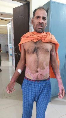 गंभीर झुलसे युवक का सीएचसी में सफल इलाज