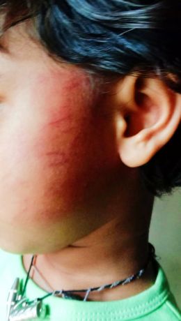 3 साल की बच्ची को शिक्षक ने थप्पड़ मारा