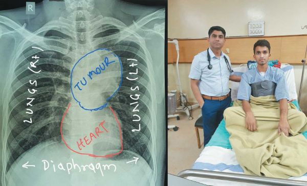   युवक को दो महीने से खांसी, सांस लेने में हो रही थी परेशानी, अम्बेडकर में सर्जरी कर बचाया