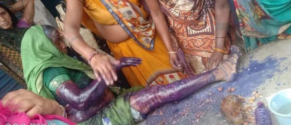 गैस सिलेंडर विस्फोट से झुलसी बुजुर्ग महिला 