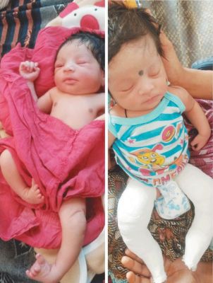 वंशिका के पैरों के सफल ऑपरेशन से लौटी माता-पिता की मुस्कान