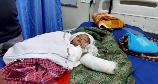 5 माह की मासूम आग से झुलसी
