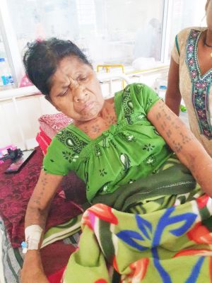 मेकाज के डॉक्टरों ने खराब हो चुके घुटने को बदल लगाया घुटना