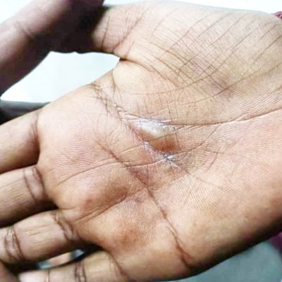शौचालय में गंदगी, उप शाला नायक ने खौलते तेल से जलाया सहपाठियों का हाथ