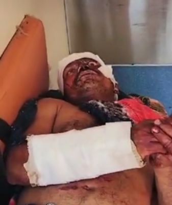 तेंदूपत्ता तोड़ते ग्रामीण पर भालू का हमला,जख्मी