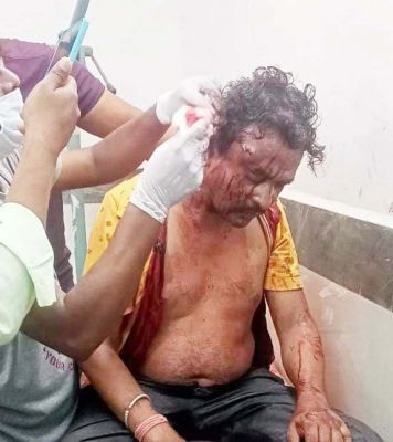 फिंगेश्वर नपं कर्मचारी पर जानलेवा हमला, खून से लथपथ अस्पताल पहुंचा 