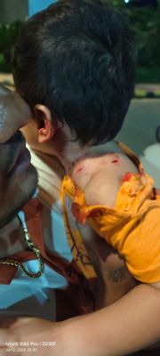 कुत्तों के झुंड ने मासूम को जगह-जगह काटा,  लोगों ने बचाया 