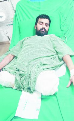दुर्घटना में कट गये थे दोनों पांव, फिर भी बचा ली जान