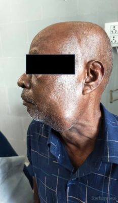 सिम्स के चिकित्सकों ने कैंसर के चौथे स्टेज के मरीज को दी नई जिंदगी