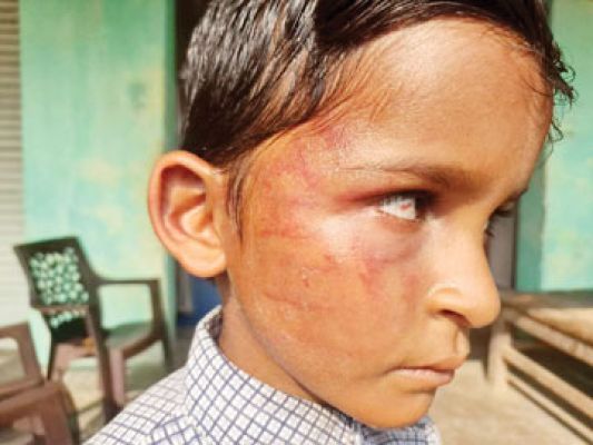  गिनती न सुना पाया, शिक्षक पर पिटाई का आरोप, दूसरी के छात्र की आंख में चोट   